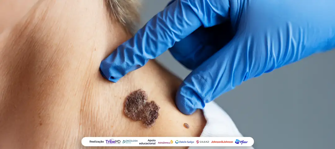 LBA61 – Interrupção precoce da terapia anti-PD-1 em pacientes com melanoma metastático: resultados do Safe Stop Trial