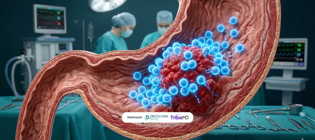 NEOSUMMIT-01: imunoterapia perioperatória no câncer gástrico ressecável