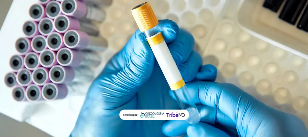 Rastreamento Sem Especulo: A Autocoleta para HPV Chega às Diretrizes Americanas e Pode Transformar a Prevenção do Câncer de Colo Uterino