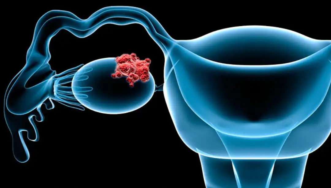 El ensayo fase 2/3 REJOICE-Ovarian01 muestra que raludotatug deruxtecán muestra tasas de respuesta clínicamente significativas en cáncer de ovario, peritoneal primario o de trompas de Falopio recurrente resistente al platino.