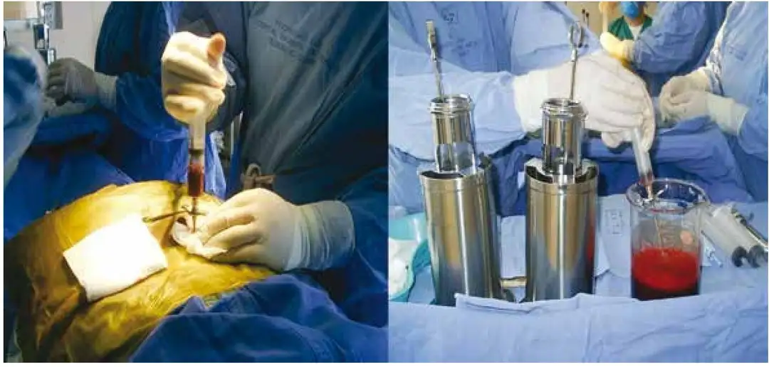 Resultados tras el trasplante de células hematopoyéticas haploidénticas de médula ósea frente a sangre periférica utilizando profilaxis de la enfermedad de injerto contra huésped basada en ciclofosfamida postrasplante.