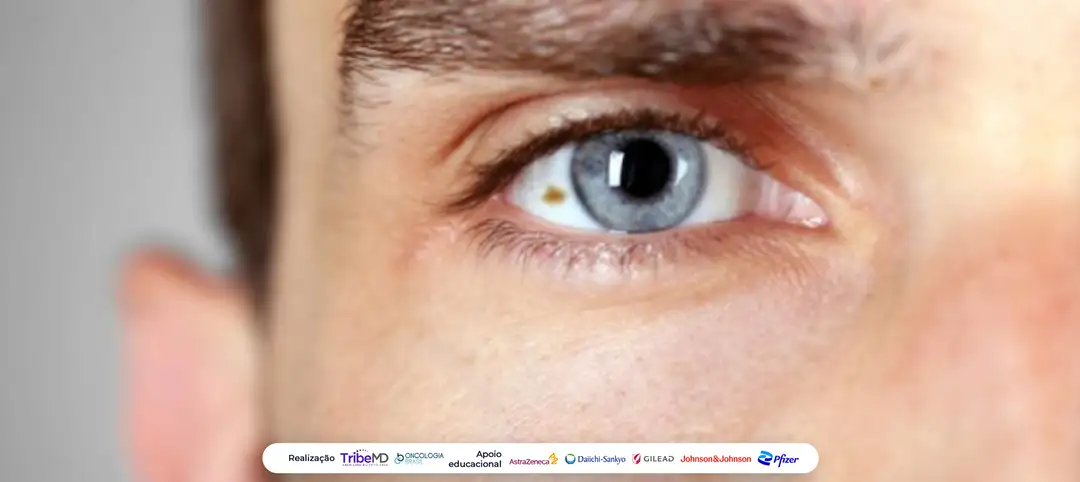 Terapia celular IMA-203 mostra resultados promissores em melanoma uveal avançado